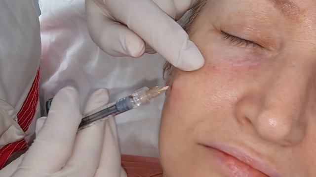 See how Sofiderm make a miracle on cheek filling. смотреть онлайн