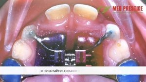 Аппарат Хааса в ортодонтии