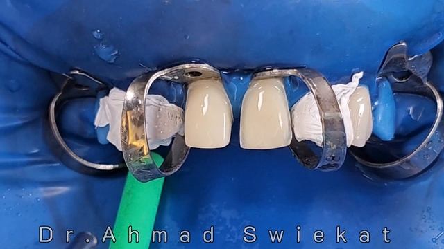 veneers cementation under rubber dam step by step смотреть онлайн