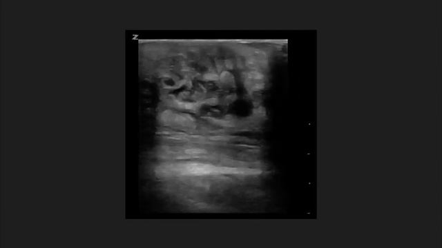 Soft Tissue POCUS (Ultrasound) смотреть онлайн