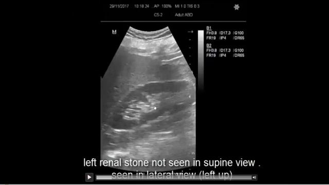 ULTRASOUND RENAL STONE DIFFERENTIAL DIAGNOSIS смотреть онлайн