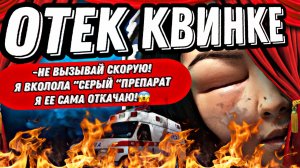 ОТЕК КВИНКЕ В ТРЕШ КЛИНИКЕ/СЕРЫЕ ПРЕПАРАТЫ/СОТРУДНИКИ БЕЗ МЕД ОБРАЗОВАНИЯ?