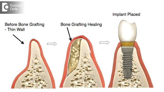 Is Bone Graft Essential For Dental Implants? - Dr. Sudhakara Reddy