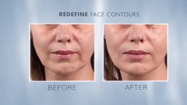 Teosyal® Filler By Teoxane