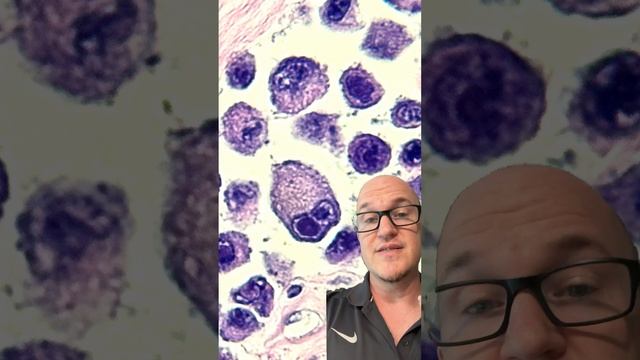 Day 7: Malignant Melanoma and the Bug Eyed Demon #melanoma #medicine #medicalstudent #pathology смотреть онлайн