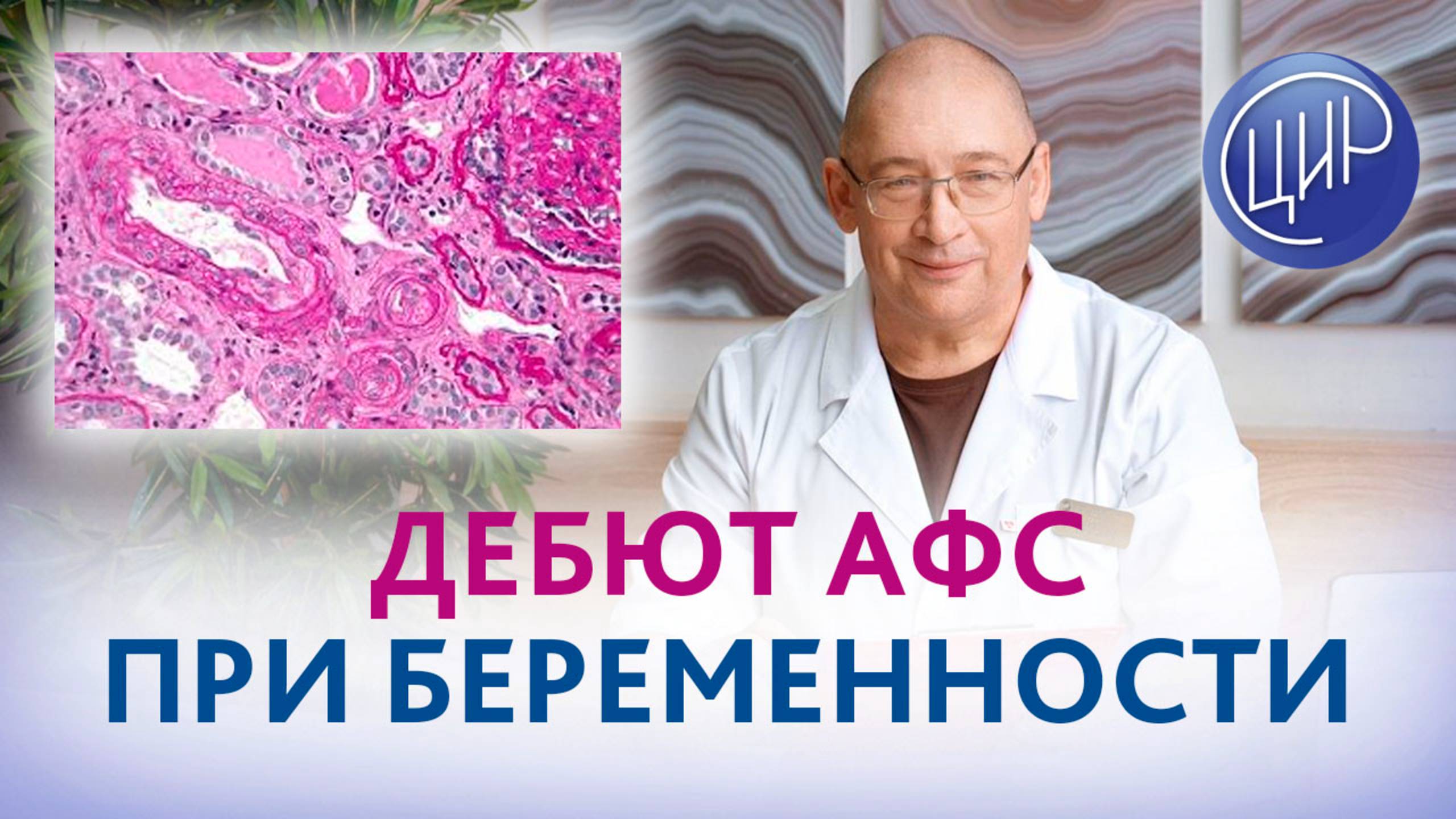 Может ли АФС - антифосфолипидный синдром - появиться во время беременности? смотреть онлайн
