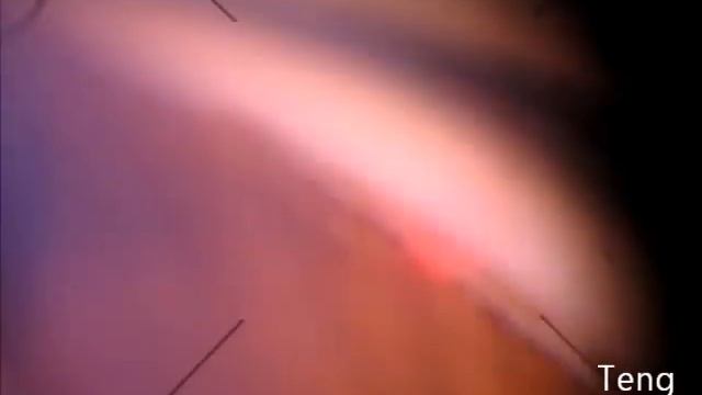 Selective Laser Trabeculoplasty (SLT) Compilation. Chris Teng, MD смотреть онлайн