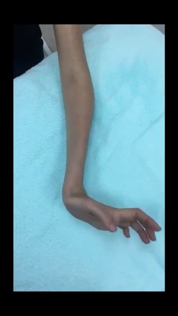 Кисть. Повреждение TFCC после операции