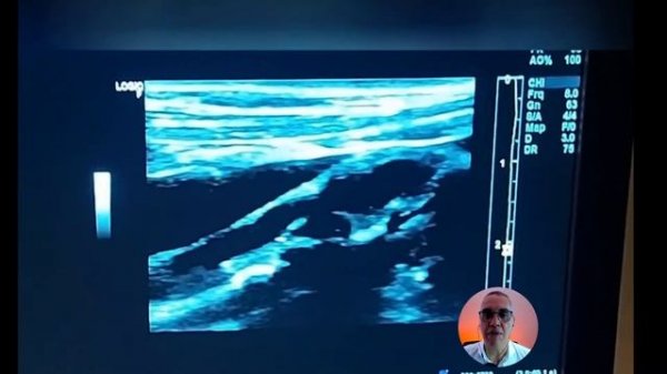 PLAQUE-RADS - Uma Nova Abordagem para Qualificação da Estenose Carotídea