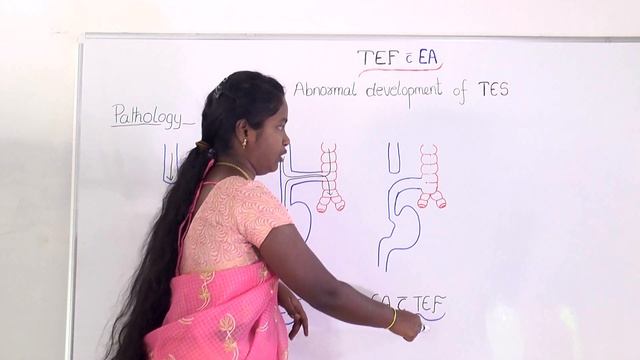 Esophageal atresia with TEF (Part-2) смотреть онлайн