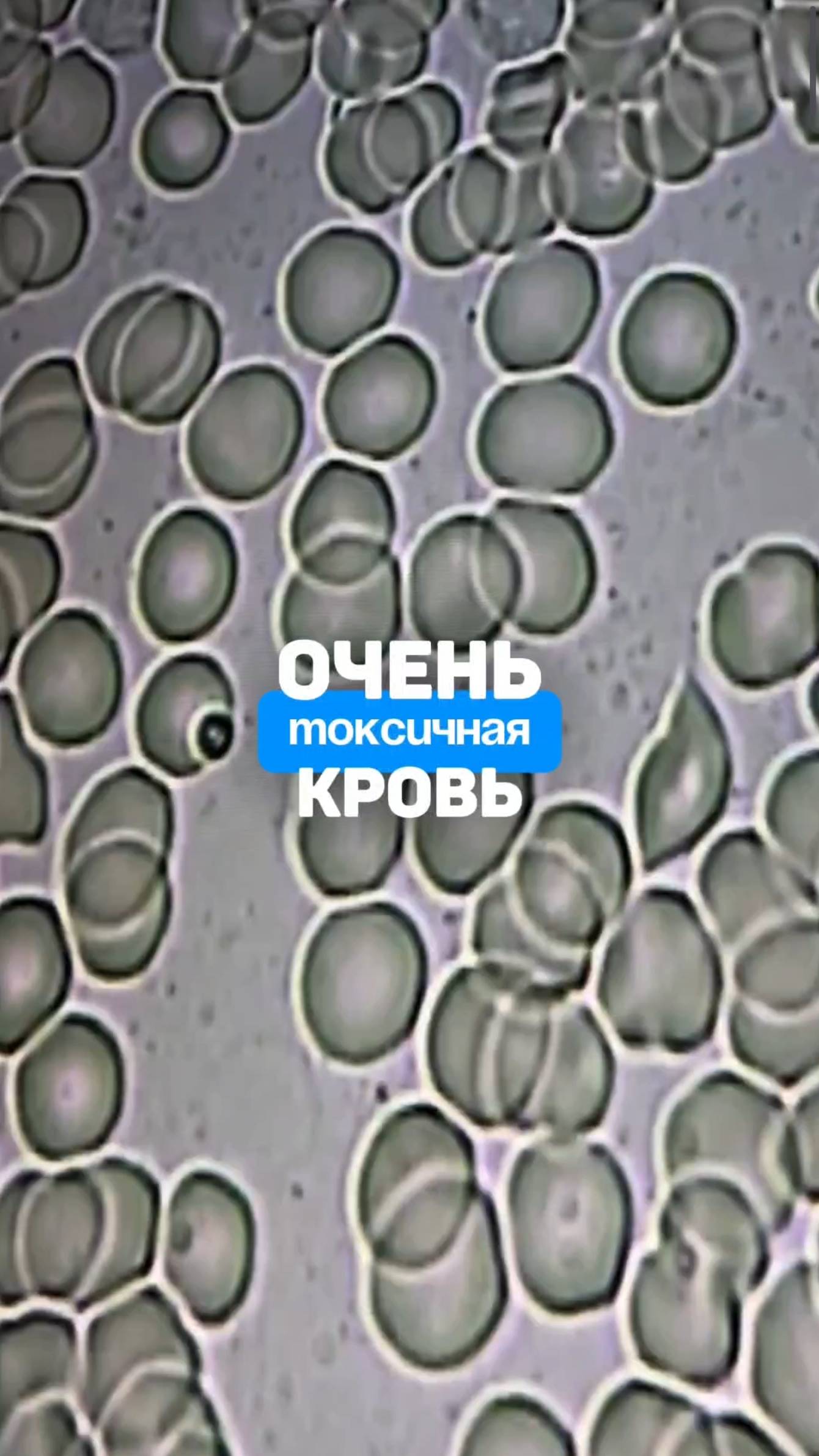 Токсичная кровь. Откуда бактерии в крови? Алена Братишко смотреть онлайн