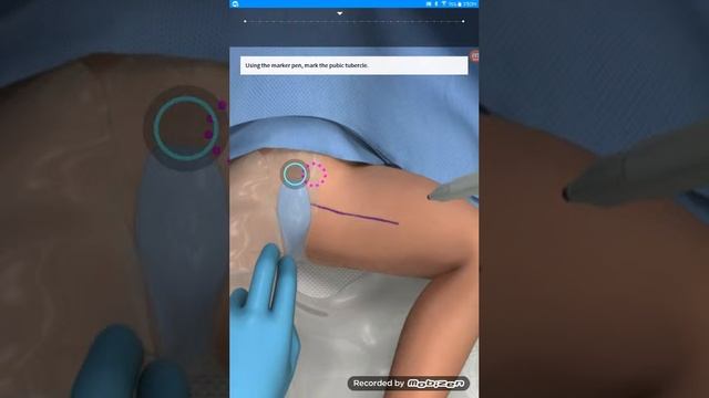 ORTOPEDIA, Septica de cadera pediatrica. FASE 1/4: La aspiracion de la cadera смотреть онлайн