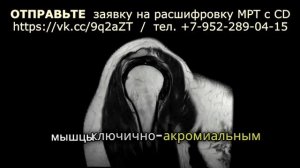 АРТРОЗ акромиально ключичного сочленения и РАЗРЫВ суставной губы (РАСШИФРОВКА МРТ плечевого сустава