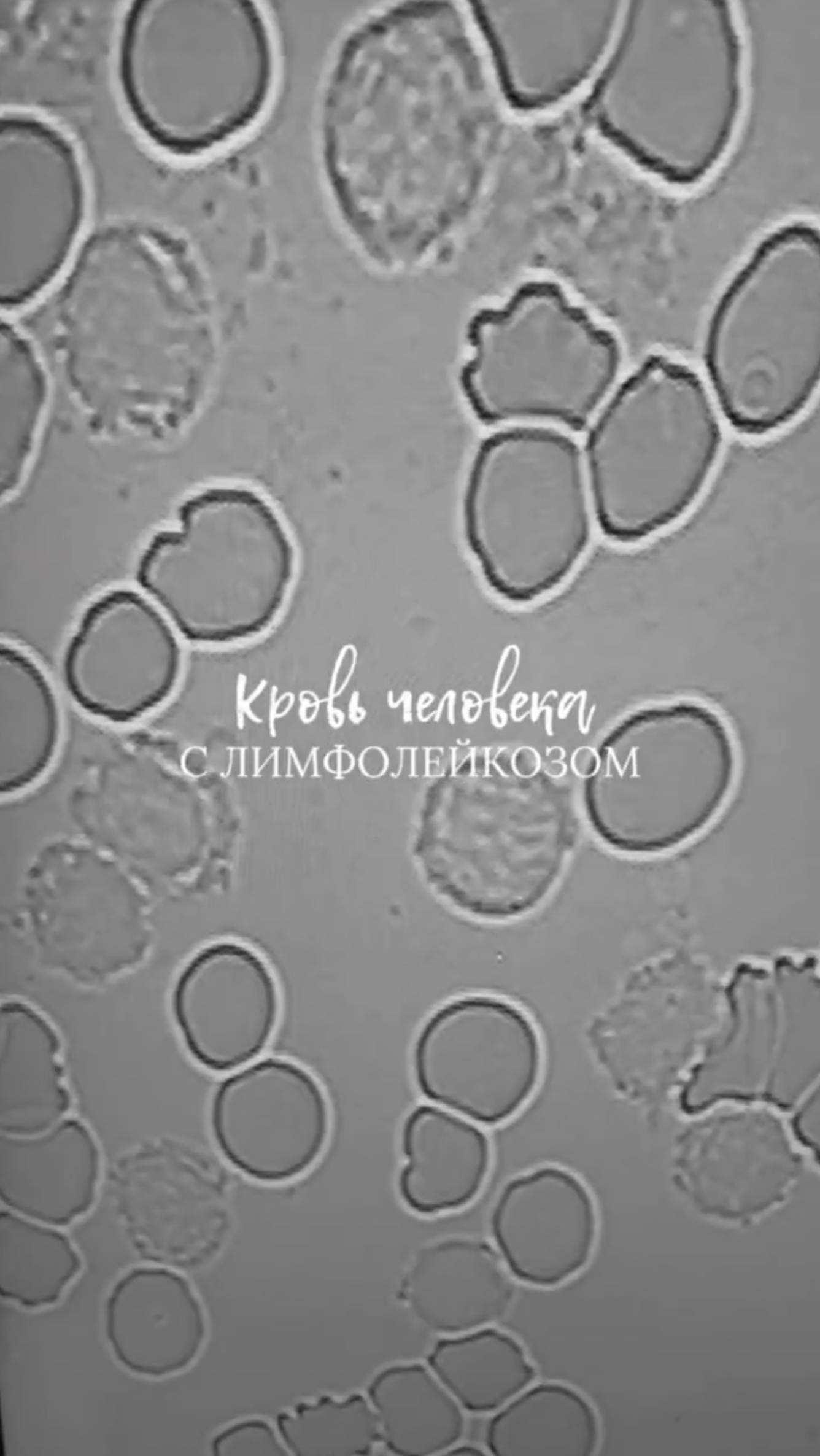 Кровь человека с лимфолейкозом смотреть онлайн