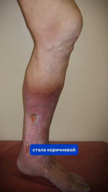 Когда пора к флебологу ⏰ Проверьте себя