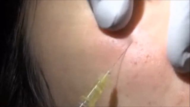 CURENEX(PDRN+Multi Peptides) With Cannula Injection