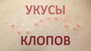 Как выглядят укусы постельных клопов и как отличить их от укусов других насекомых?