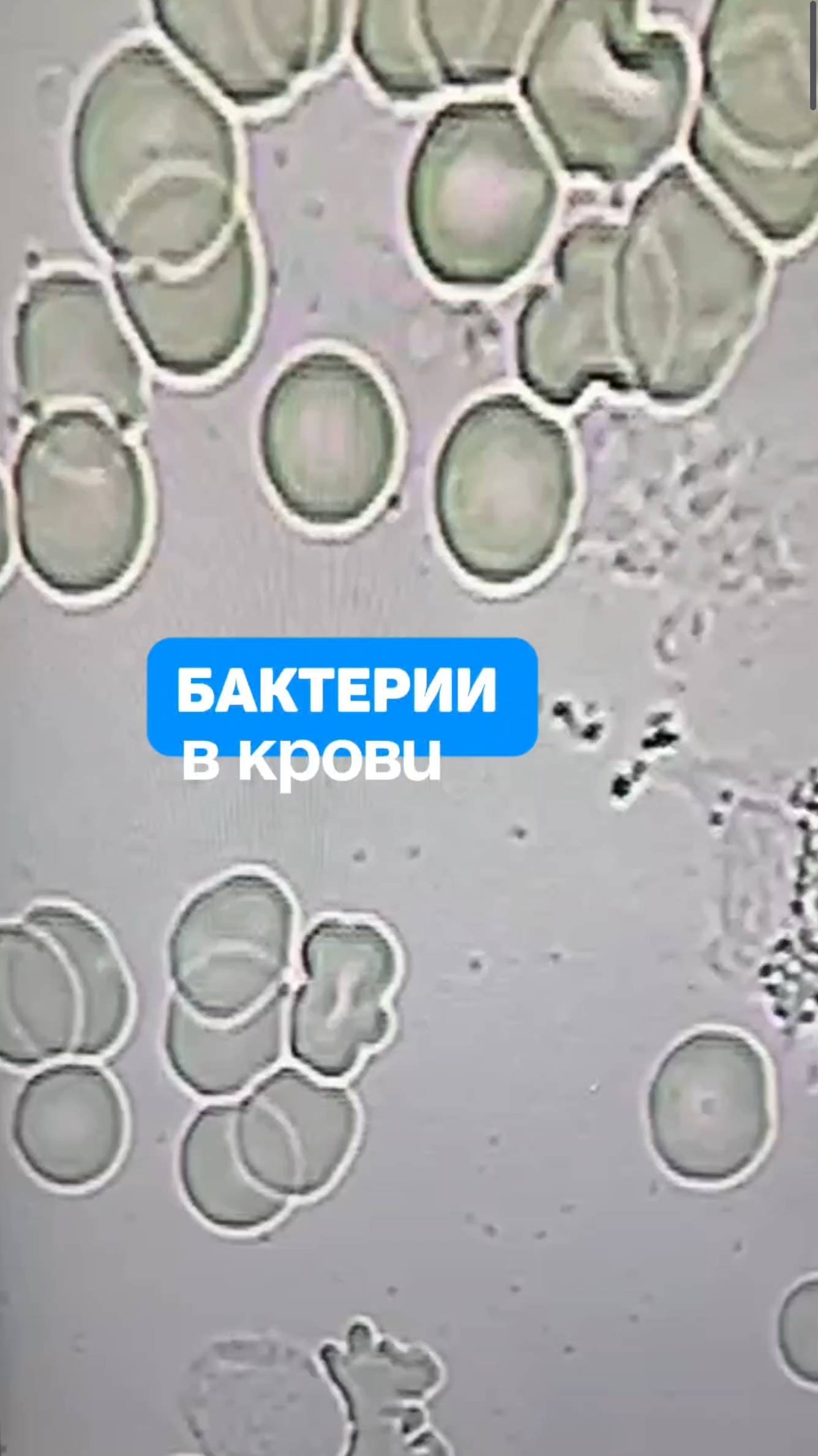 Бактерии в крови смотреть онлайн