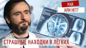 КТ лёгких: 3 страшных “диагноза”, которые не так опасны, как кажется