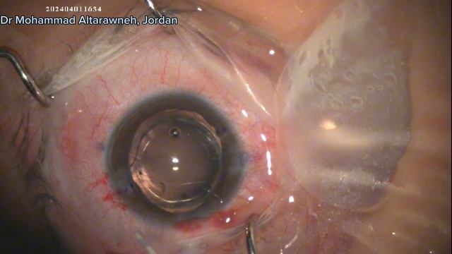 4 through pupillopalsty, toric iol, in pkp with Urrets-Zavalia смотреть онлайн
