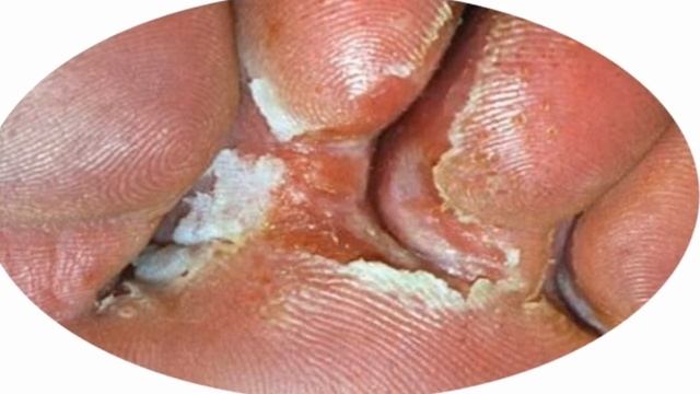 Travocort cream usesprice  How to use travocort cream in urdu hindi