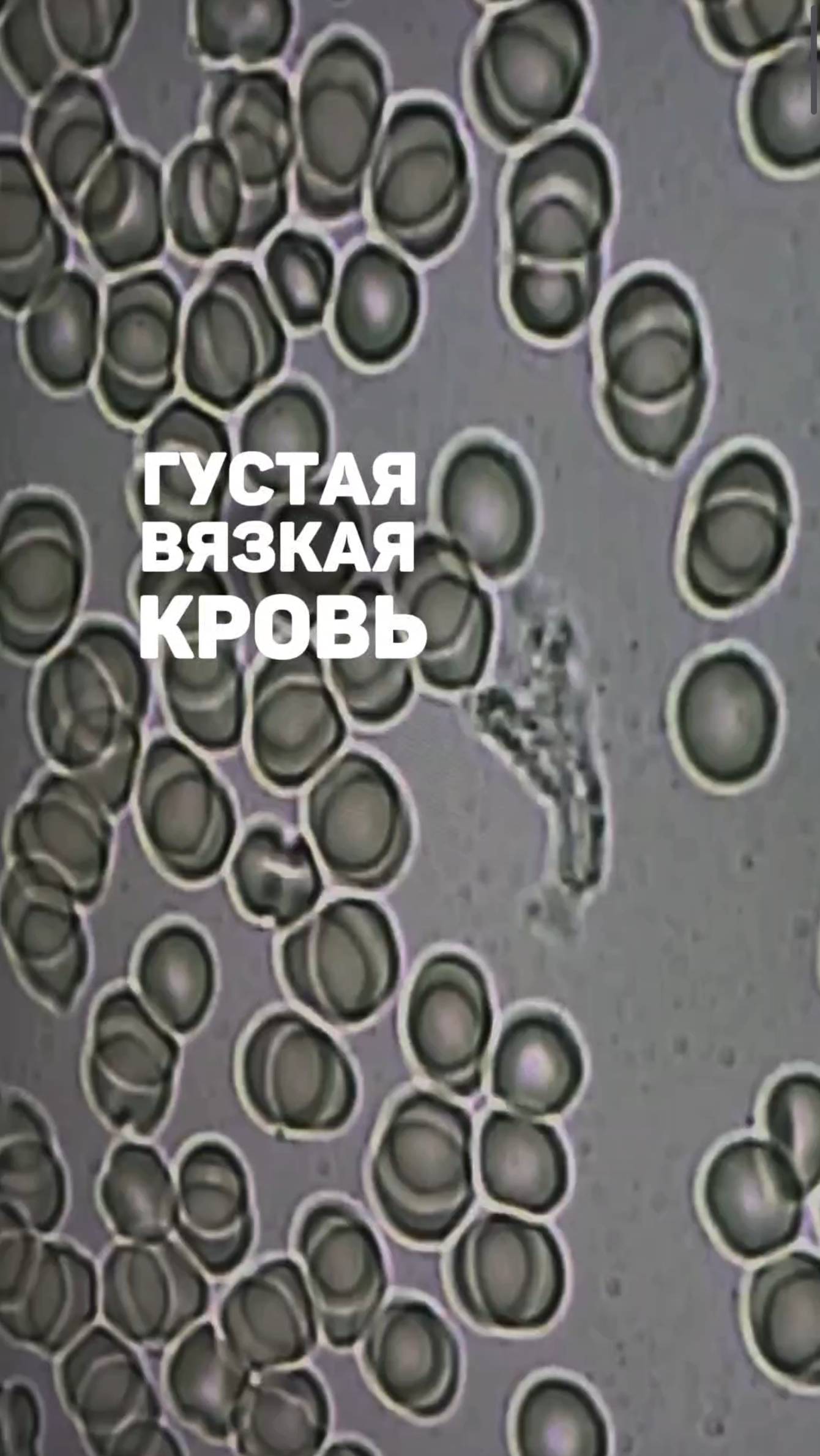 Густая вязкая кровь под микроскопом. Алена Братишко смотреть онлайн