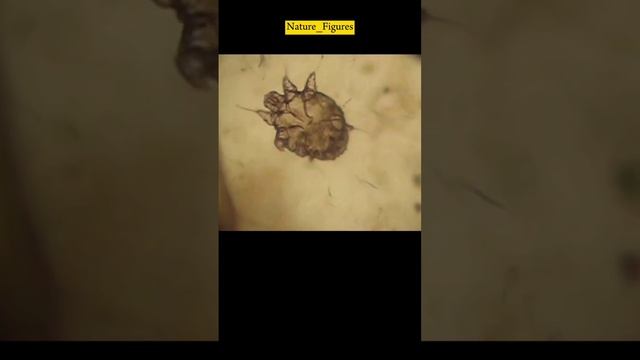 Sarcoptes Mites | causes of scabies смотреть онлайн