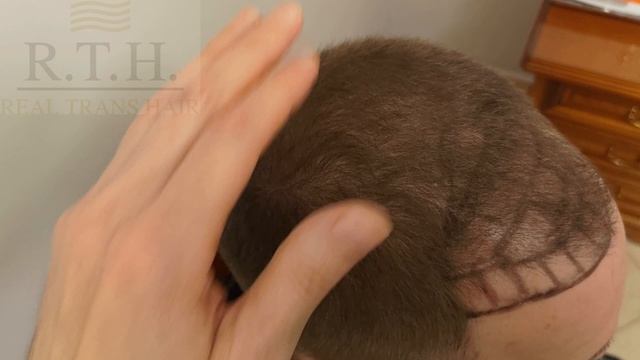 Пересадка волос. Результат сразу после процедуры, через три и шесть месяцев. смотреть онлайн