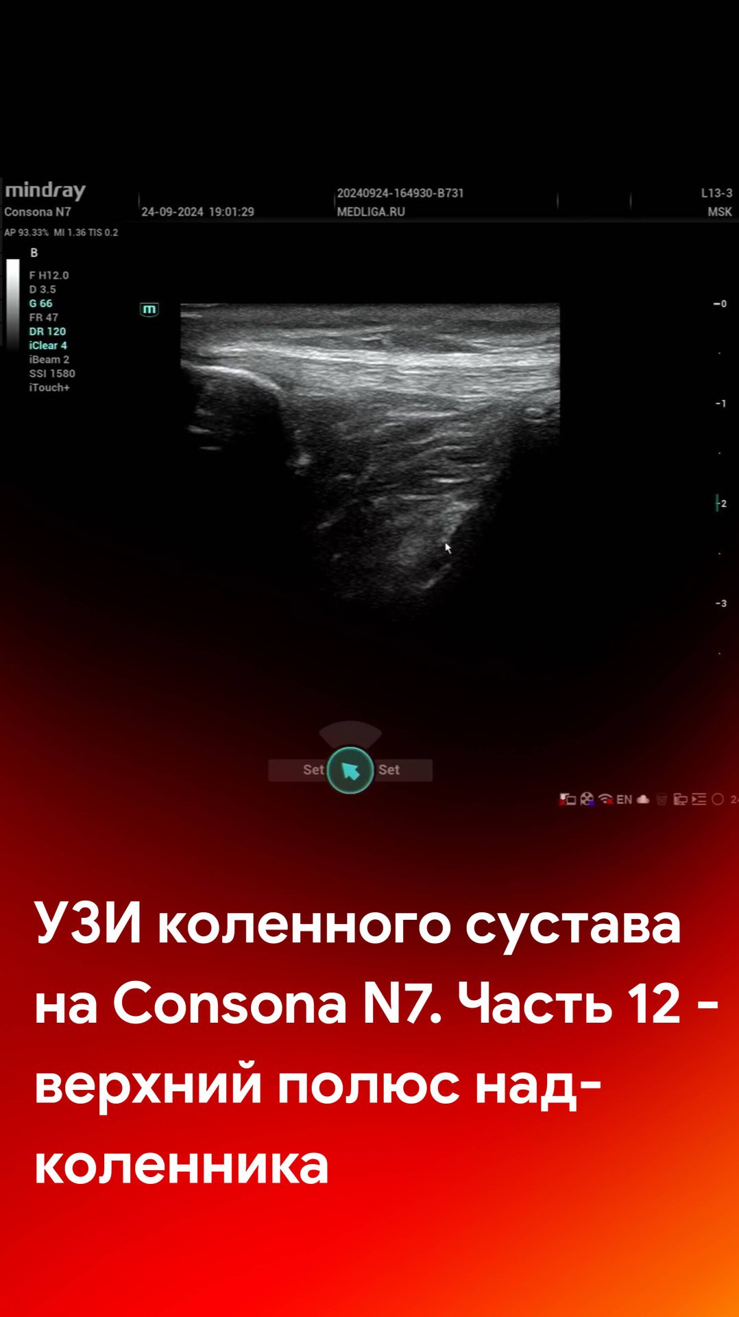 УЗИ коленного сустава на Mindray Consona N7. Часть 12 - верхний полюс надколенника смотреть онлайн