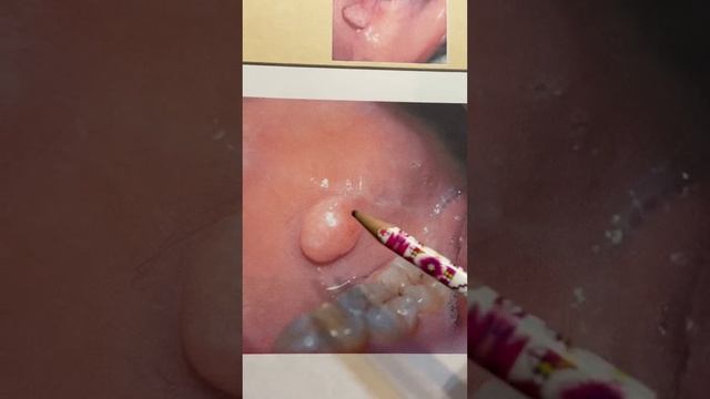 Фиброма смотреть онлайн