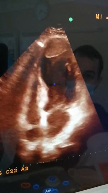 Extensive LV infarction, apical aneurysm, apical thrombus, EF 25%, Male 70y смотреть онлайн