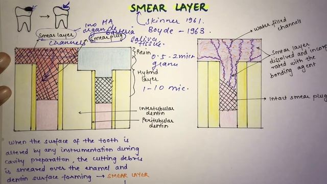 SMEAR LAYER || DENTIN BONDING AGENTS || DENTAL MATERIALS смотреть онлайн