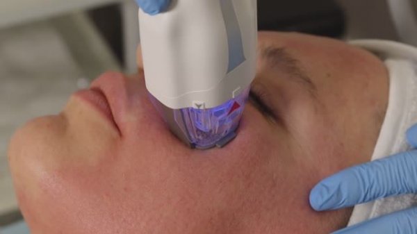 RF-лифтинг Vivace Virtue RF