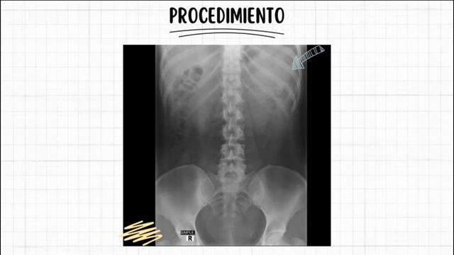 COLON POR ENEMA(ENEMA OPACO) |ESTUDIO RADIOLÓGICO #radiologia #radiology  #medico