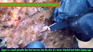 Satisfying Video of Jiggers removal😲😲😲