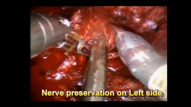 Dr Himesh Gandhi shows Robotic Radical Prostatectomy with Bilateral Pelvic lymphnode dissection смотреть онлайн