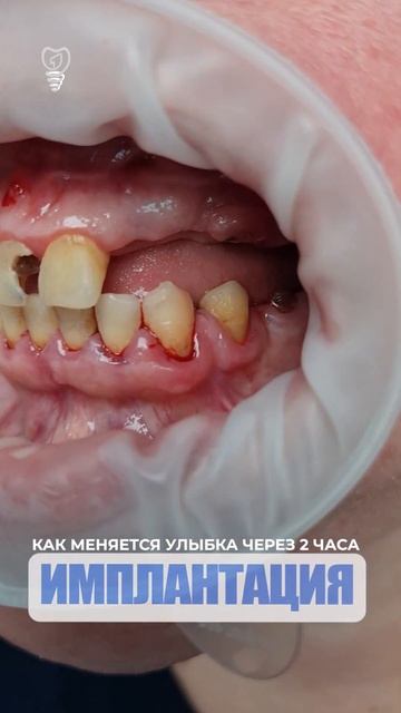Как меняется улыбка через 2 часа. How smile changes after 2 hours. Implantation. смотреть онлайн