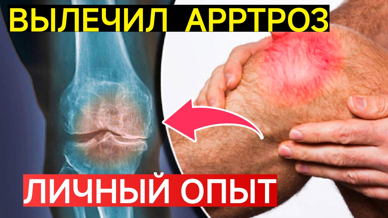 КАК Я ВЫЛЕЧИЛ СУСТАВЫ? ЛИЧНЫЙ ОПЫТ. БОЛЬНЫЕ КОЛЕНИ.АРТРОЗ.ХОНДРОЗ.ОСТЕОПОРОЗ.СТАРЫЙ НАРОДНЫЙ РЕЦЕПТ.