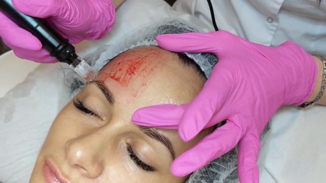 Dermapen Microneedling in London | Full Procedure смотреть онлайн