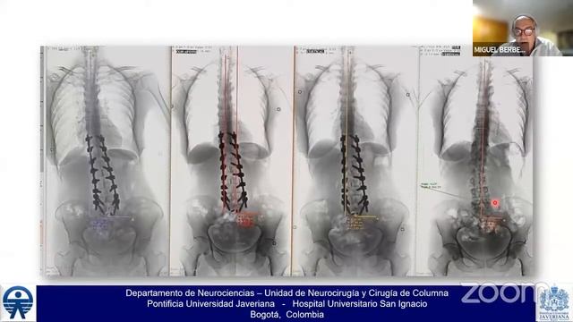Universidad Flanc | Módulo de Columna: Patología Degenerativa de Columna смотреть онлайн