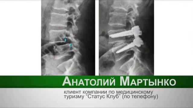 Замена суставов, лечение позвоночника в Корее смотреть онлайн