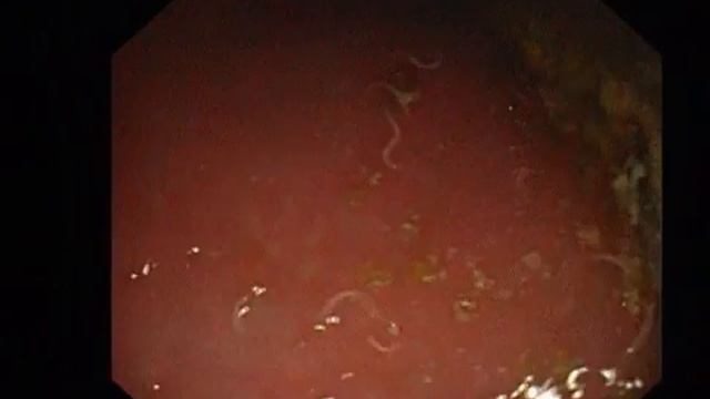 massive worm infestation of colon смотреть онлайн