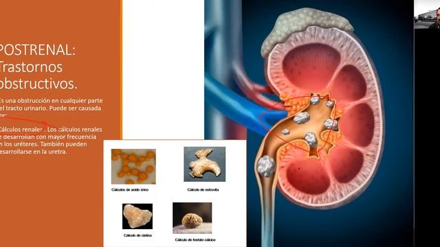 Fisiopatologia renal, parte 2, Insuficiencia Renal Aguda смотреть онлайн