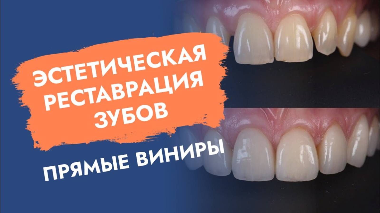 Виниры за один час! Кому показаны? Как делать?