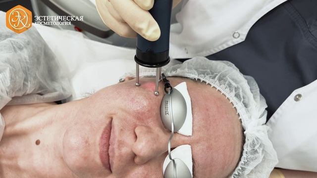 Лазерная шлифовка смотреть онлайн