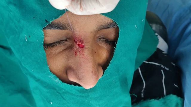 Scar Revision Surgery to get rid of obvious scar| Facial Aesthetic Surgeon DR VARUN NAMBIAR, Kerala смотреть онлайн