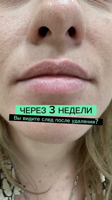 Удаление родинок БЕЗ СЛЕДА — реально👌🏻#бородавки #лазерноеудаление #папилломы #удалениеродинки смотреть онлайн