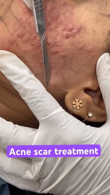 #acnescarremoval #vjdeepika #acnevulgaris #acneproneskin #babybotox #faceacne смотреть онлайн