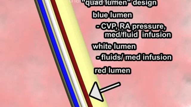 Swan Ganz Pulmonary Artery Catheter Animation By Cal Shipley, M.D.