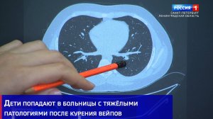 Дети попадают в больницы с тяжёлыми патологиями после курения вейпов
